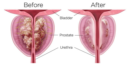 Rezum Prostate BPH Before and After