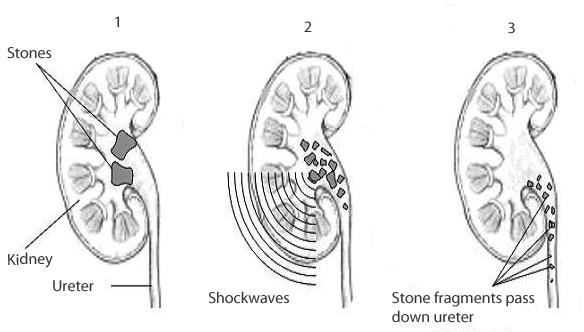 Shockwave Treatment Kidney Stones