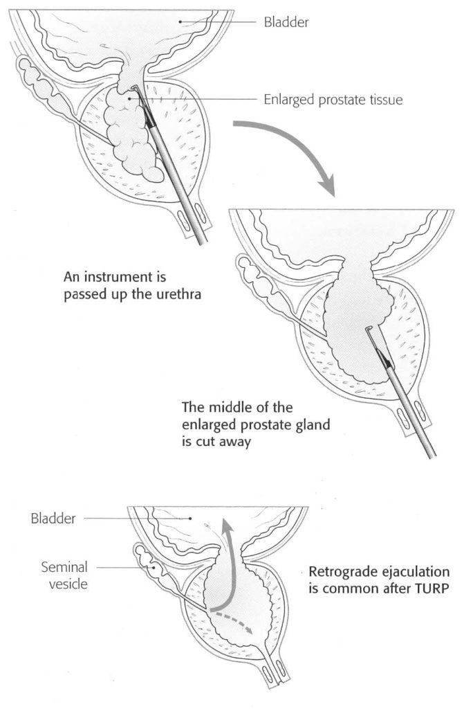 Bladder Neck Incision (B.N.I.) and Urethrotomy