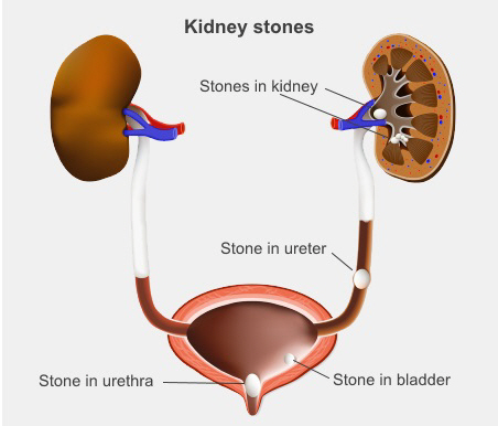 Does apple cider vinegar get rid of store kidney stones